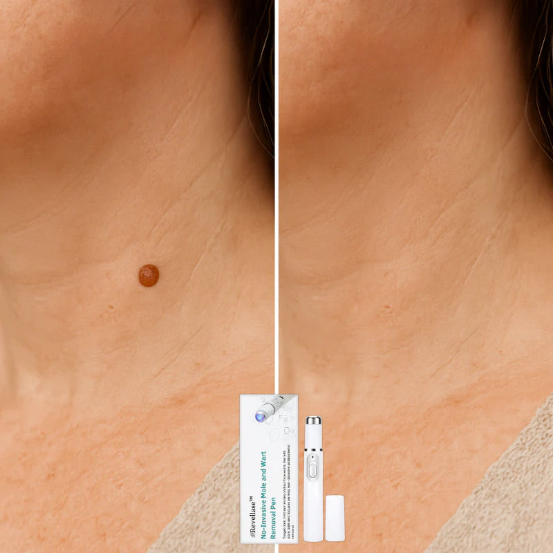Lápiz láser Derma™ para manchas cutáneas y verrugas