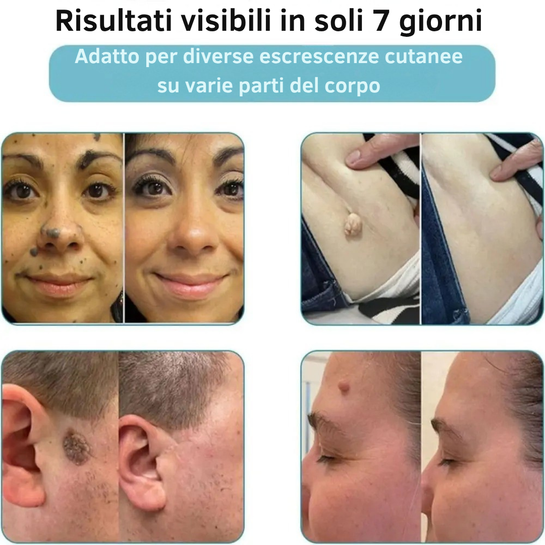 Lápiz láser Derma™ para manchas cutáneas y verrugas
